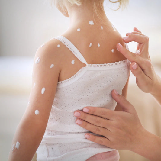 Chickenpox Recovery
privatemedicalletter.co.uk
